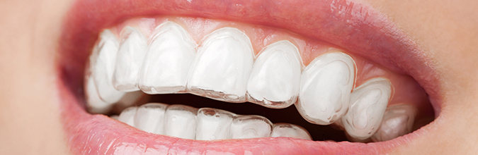 Invisible Braces are the Orthodontic Treatment of Choice!