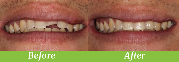 Case Study: How your dentist fixes a fractured tooth