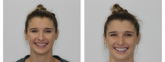veneers before and after