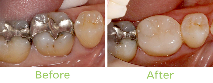 one visit crown before and after
