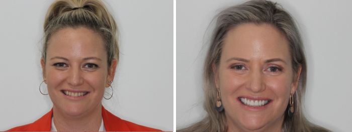Veneers Sydney Cbd