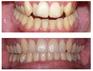 Invisalign before and after