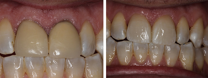 Before & After Dental Crowns Pt.2