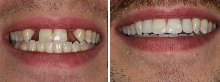 Dental Implant Insertion 1