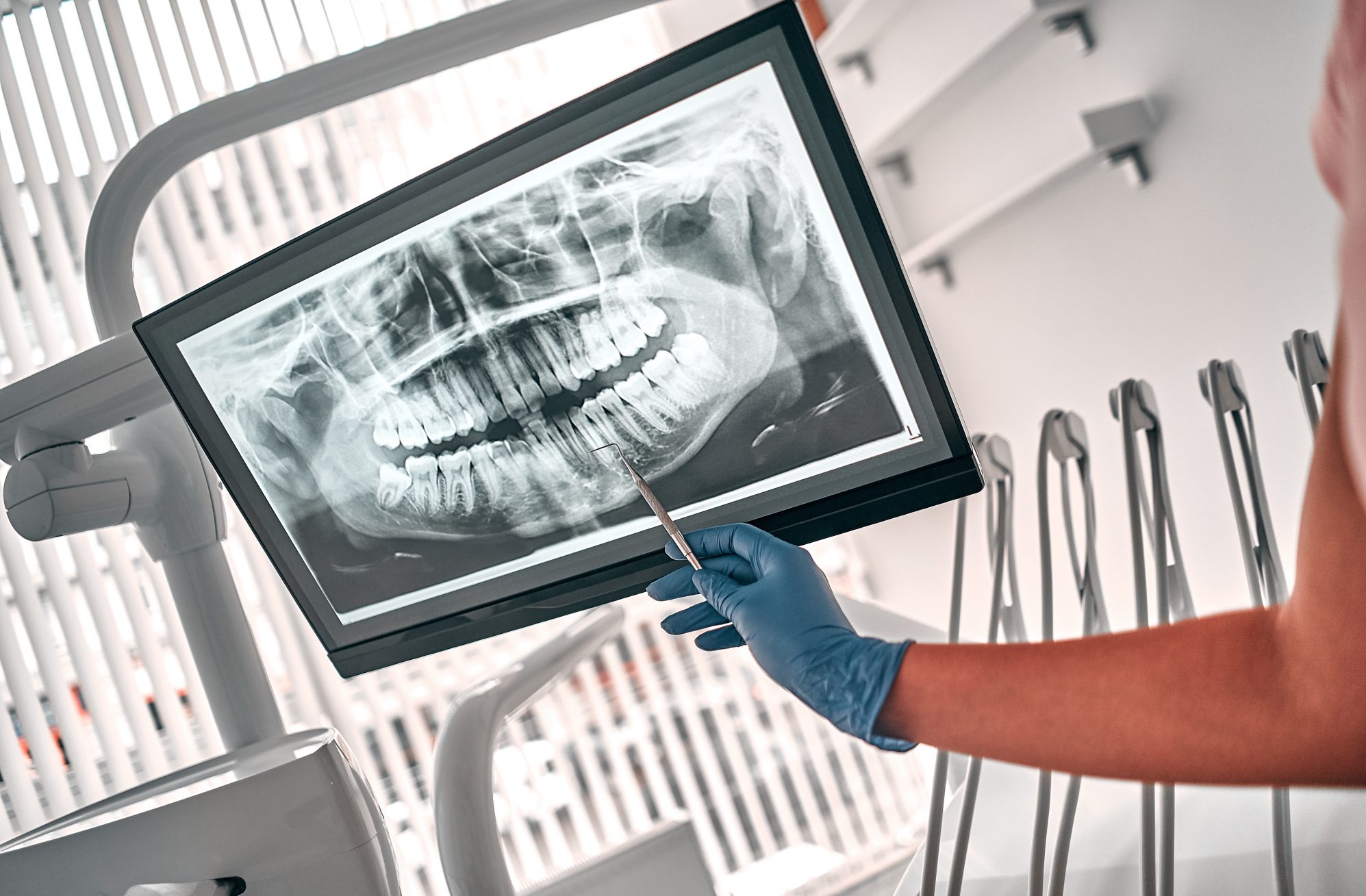 What does a cavity look like?